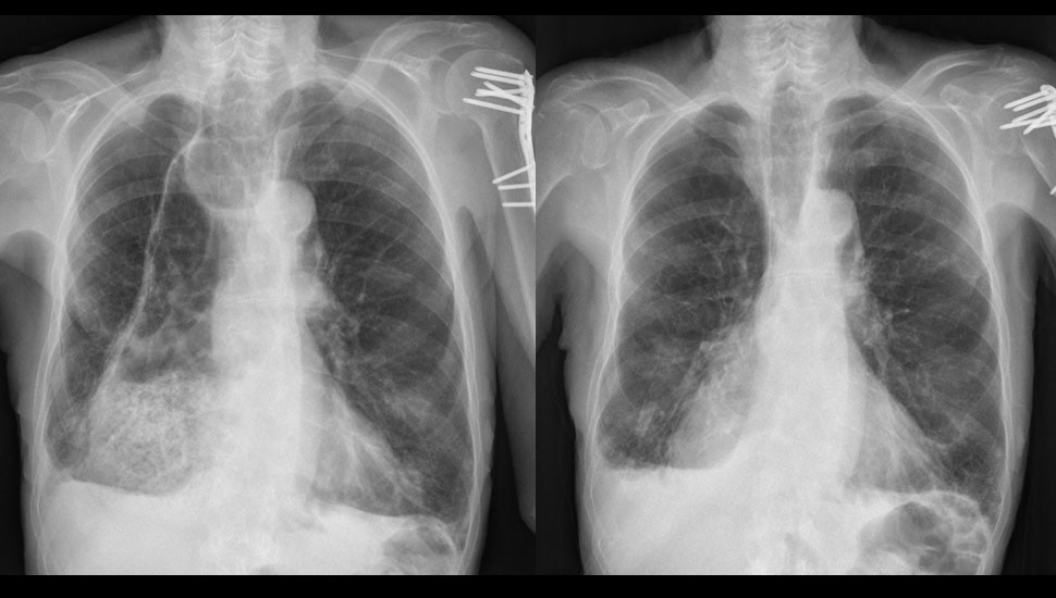 X-thorax (foto 1, links) en X-thorax na behandeling (foto 2, rechts)